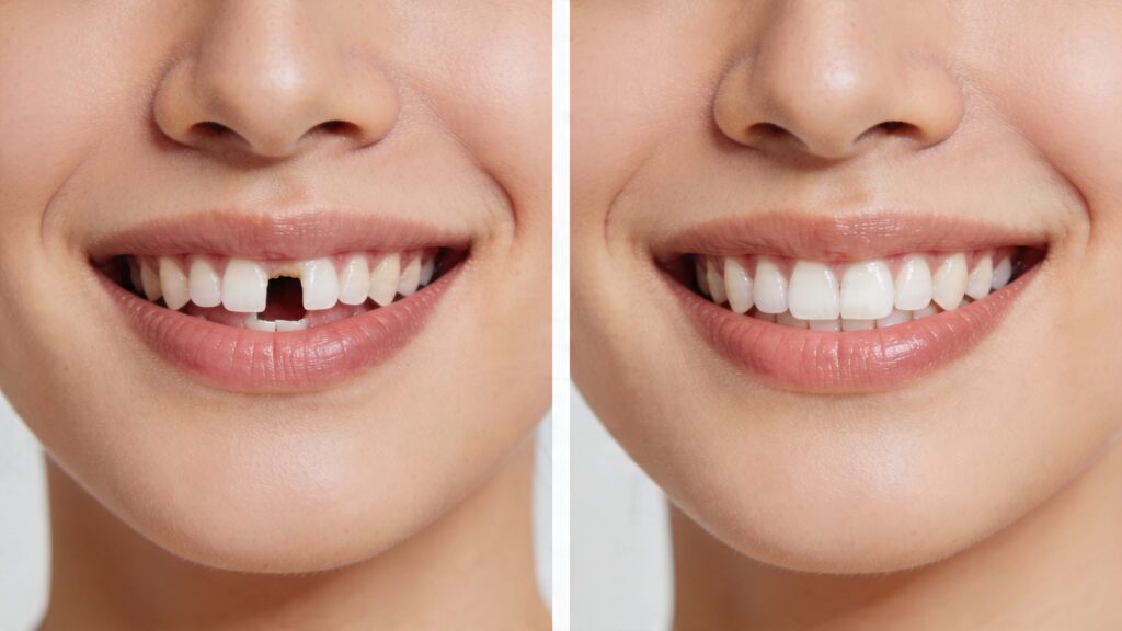 How to fix an open bite with dental treatment